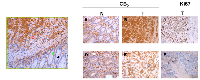 Figure 3:  Immunohistochemical staining of CB2 receptor in human colon from a colorectal cancer patient. 