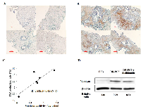 Figure 6:  Correlation of versican immunostaining with PSA reduction rate in docetaxel-resistant CRPC patients who  received docetaxel in combination with thalidomide. 