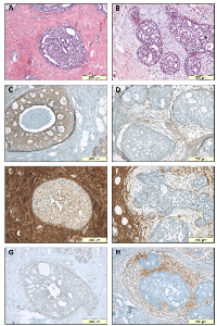 Figure  4:  Immunohistochemical  staining  of  stromal  protein  expression  in  DCIS  with  sclerotic  or  myxoid  stroma. 