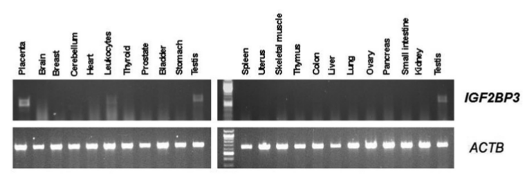 Oncoscience | Expression Of The Cancer Testis Antigen IGF2BP3 In ...