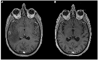 Figure 1:  Brain MRI at diagnosis and last Brain MRI performed. 