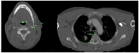 Figure 2: Axial contrast-enhanced CT scan at diagnosis. 