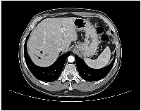 Figure 3:  Axial contrast-enhanced CT scan upon progression. 