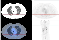 Figure 4:  PET/CT-FDG scan one month after pembrolizumab suspension. 