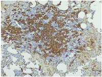 Figure 3:  Immunohistochemical staining showing CD117 (KIT) positivity in mast cells (20x magnification).