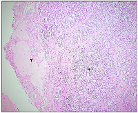 Figure 1: Pure Sertoli cell tumor in the right ovary (*) with adjacent ovarian tissue (Arrow) (4&times;).