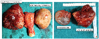 Figure 3: Post-surgery gross images of the uterus with right ovarian choriocarcinoma and left ovarian serous cystadenoma.
