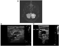 Figure 1: Multi-modality imaging findings in a patient with Trousseau&rsquo;s syndrome and metastatic colorectal cancer.