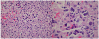 Figure 2: H&E stain showing, low power field left panel: Atypical lymphohistiocytic proliferation and high power field right panel showing Reed Sternberg cell variant.