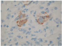 Figure 3: CD 30 Immunohistochemical stain showing scattered large and atypical cells that coexpress CD 15, MUM1, PAX 5 and EBV.