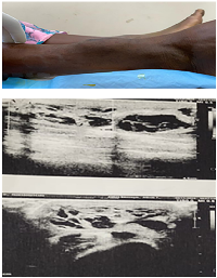 Figure 1: Swelling over anterior aspect of right leg; USG showing hypoechoic cystic lesion measuring 6.8 &times; 5 cm containing blood as content suggestive of an organised hematoma.
