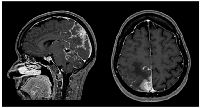 Figure 1: CE MRI at BM and LMC initial moment of diagnosis.