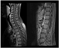 Figure 2: Neuraxis MRI at BM and LMC initial moment of diagnosis.