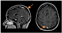 Figure 3: CE MRI response evaluation after 3 cycles of T-DXd.