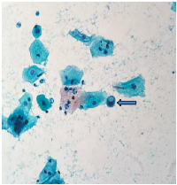 Figure 3: Smear shows a cell with cytoplasmic vacuolation (Pap stain, 400&times;).